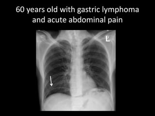 60 years old with gastric lymphoma
and acute abdominal pain
 