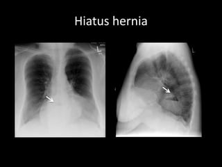 Hiatus hernia
 