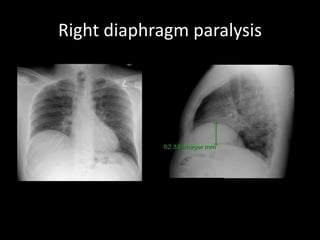 Right diaphragm paralysis
 