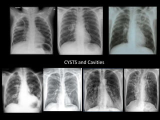 CYSTS and Cavities
 