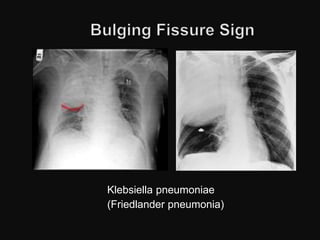 Klebsiella pneumoniae
(Friedlander pneumonia)
 