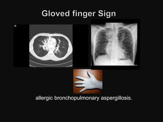 allergic bronchopulmonary aspergillosis.
 