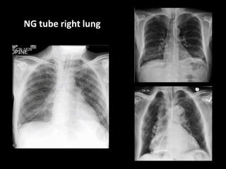 NG tube right lung
 