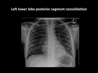 Left lower lobe posterior segment consolidation
 
