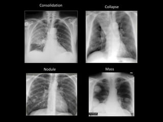 Consolidation Collapse
Nodule Mass
 