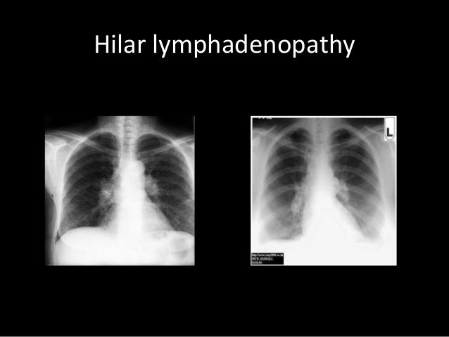 Chest X Ray Demonstrating Bilateral Hilar Lymphadenopathy In A Female ...