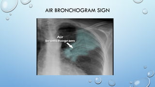 Chest x-ray Lines and stripes.pptx useful for residents | PPTX