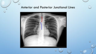 Chest Panel Line Chest x-ray Lines and stripes.pptx useful for residents | PPTX