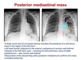 CHEST X-RAY MEDIASTINUM AND HILUMpptx.pptx
