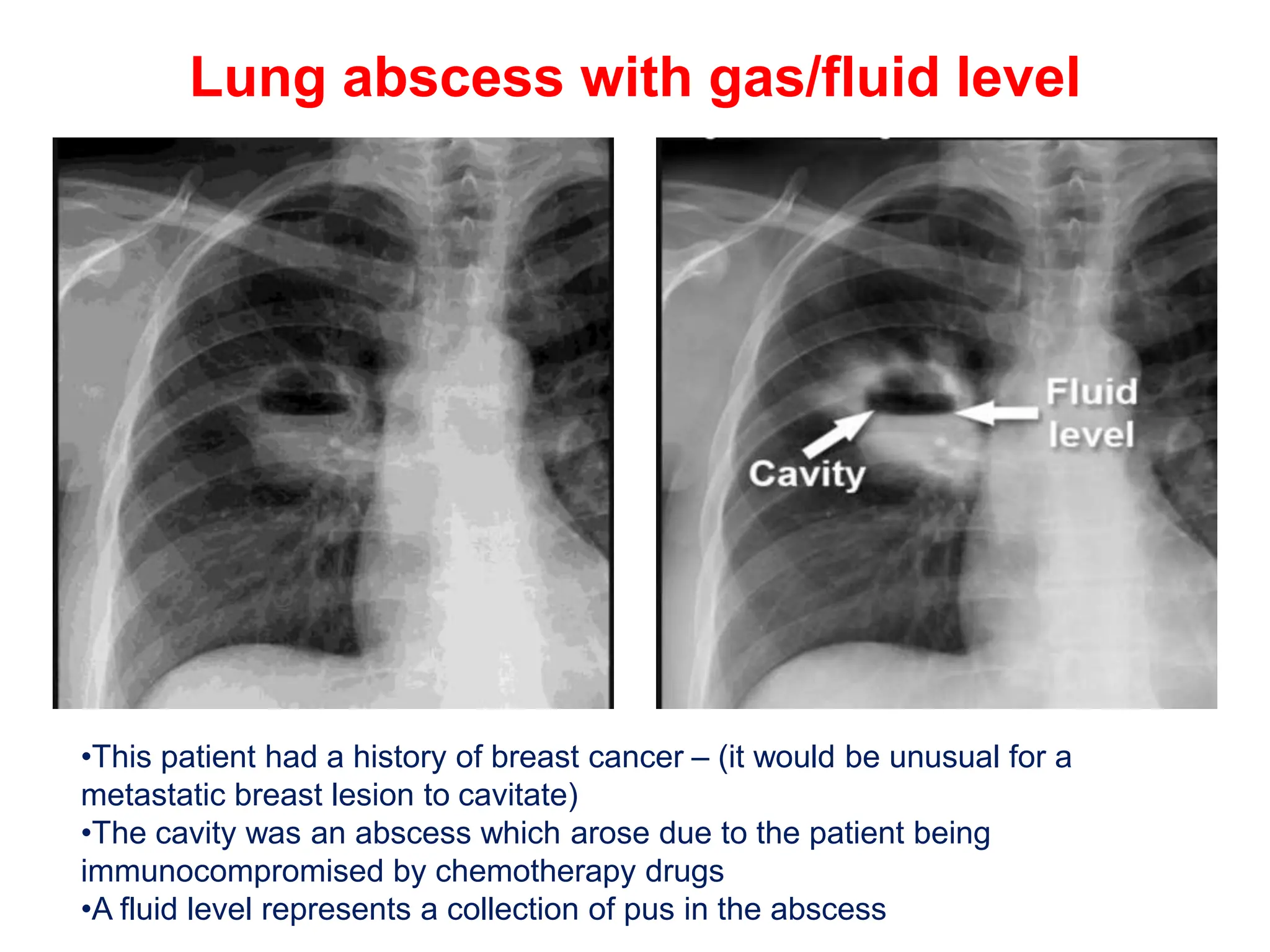 CHEST X-RAY PULMONARY DISEASE pptx.pptx