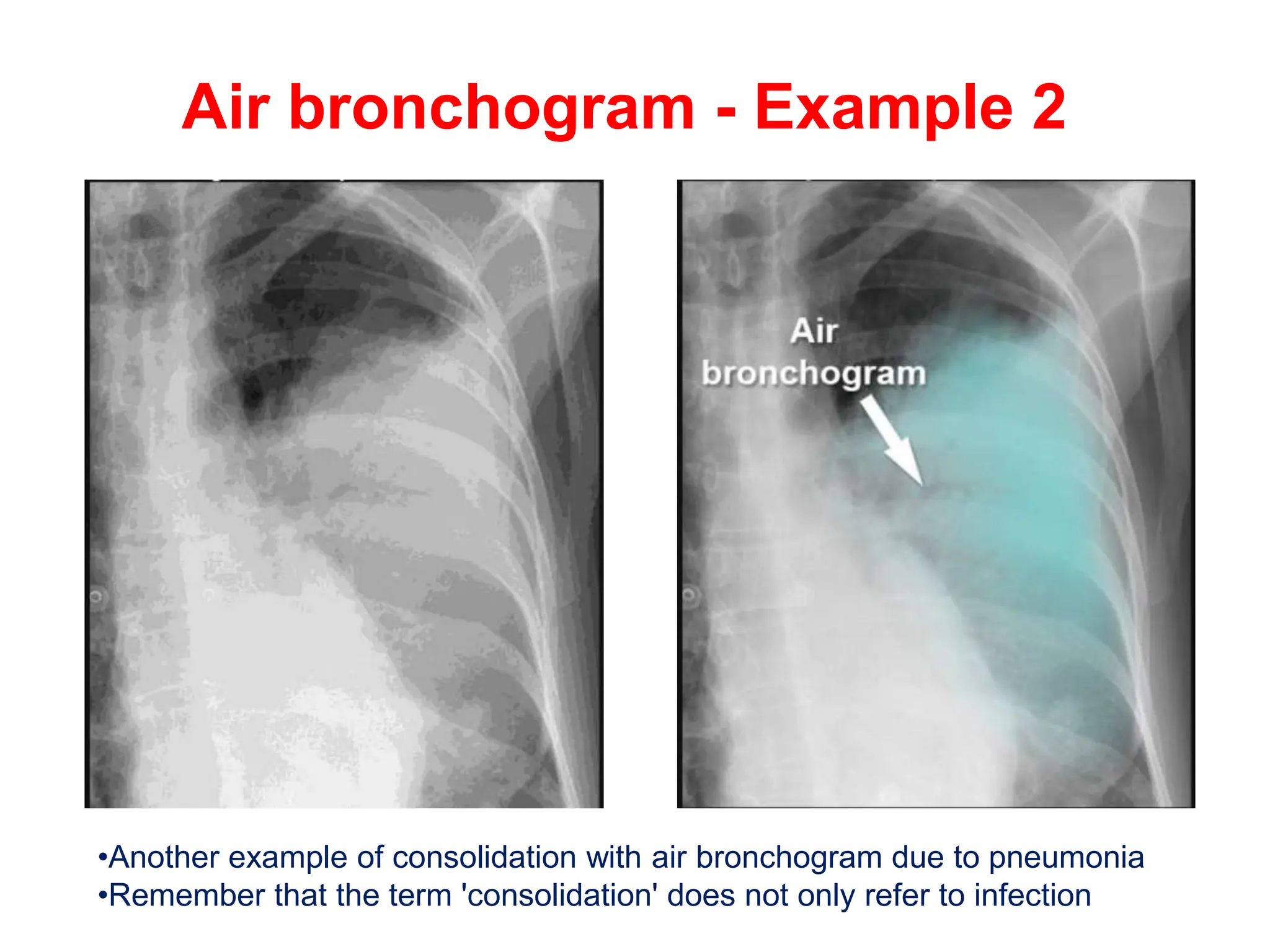 Bronchogram Sign CHEST X-RAY PULMONARY DISEASE pptx.pptx