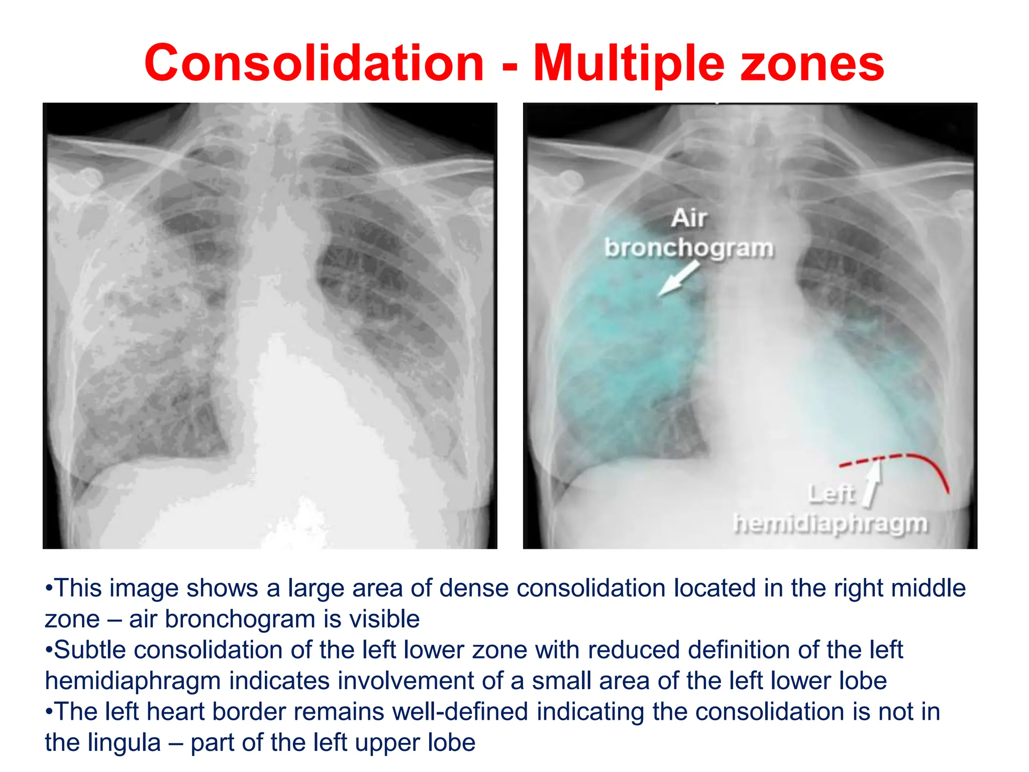 CHEST X RAY PULMONARY DISEASE Pptx pptx CHEST X RAY PULMONARY DISEASE Pptx pptx