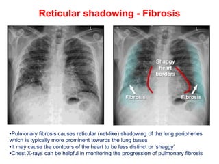 CHEST X-RAY PULMONARY DISEASE pptx.pptx