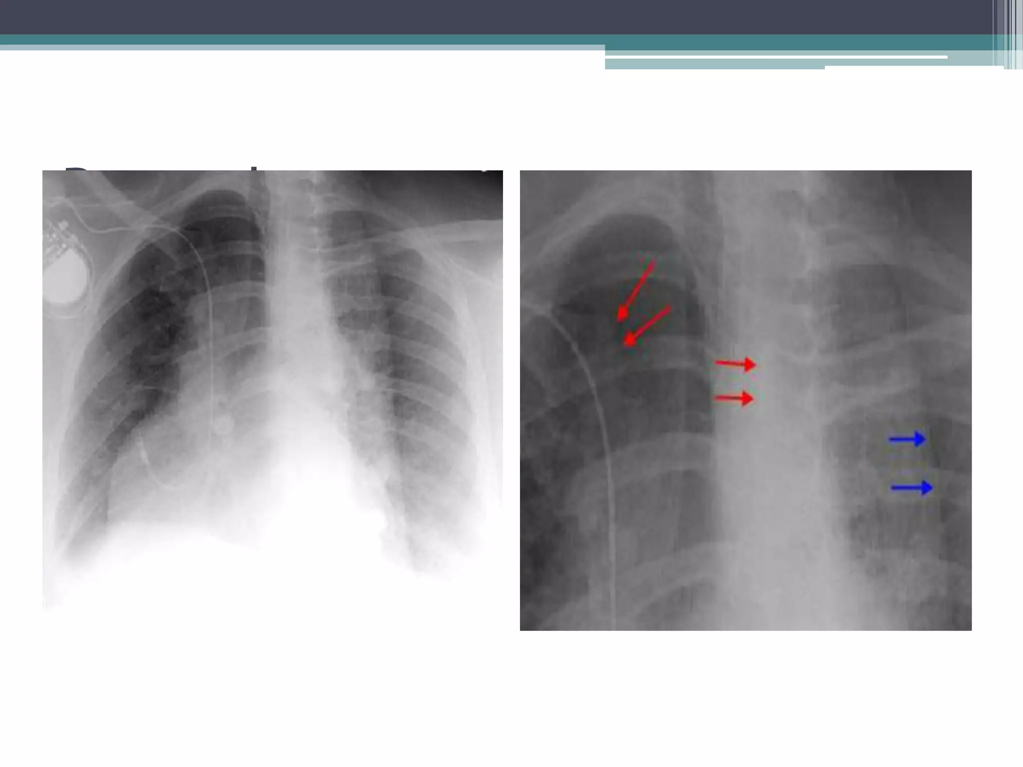 Chest X Ray Positioning Pptx