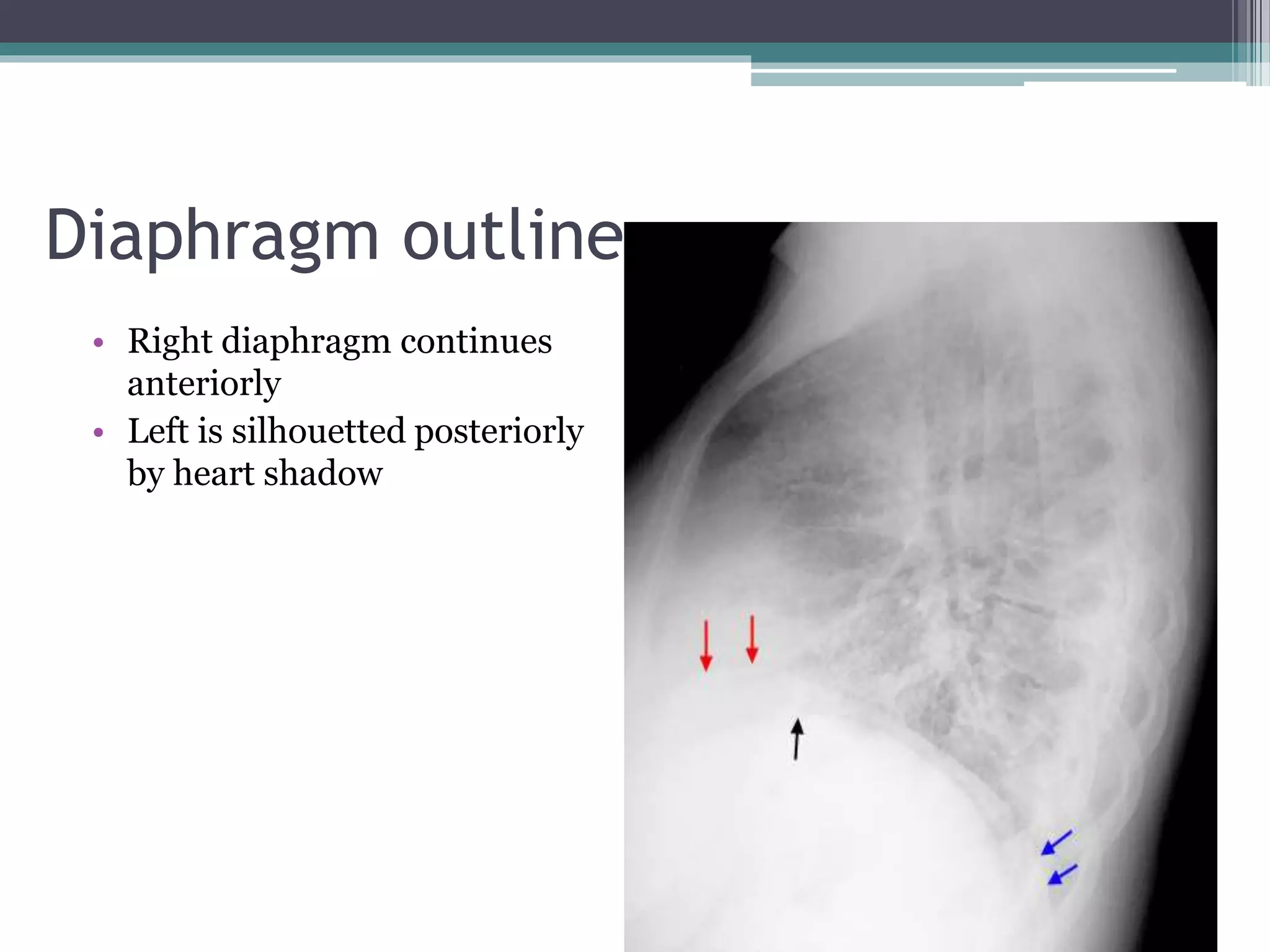 Chest x ray positioning | PPTX