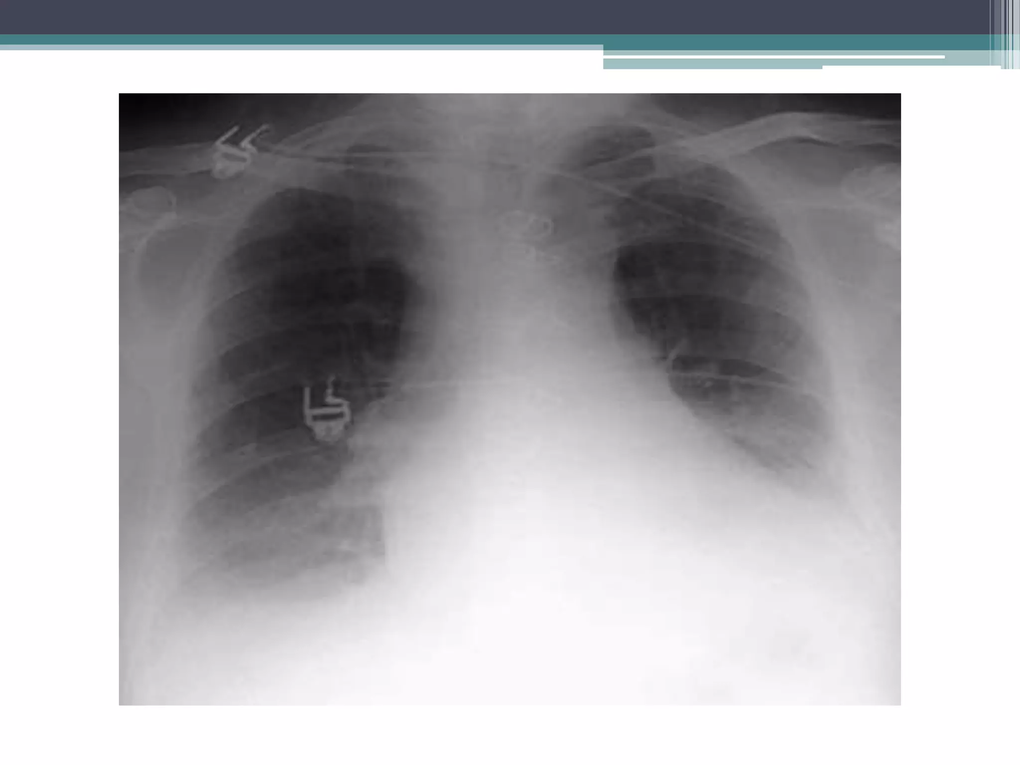 Chest x ray positioning | PPTX