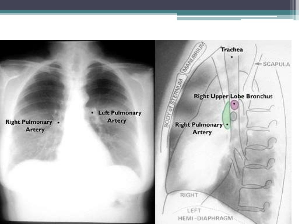 Chest x ray positioning