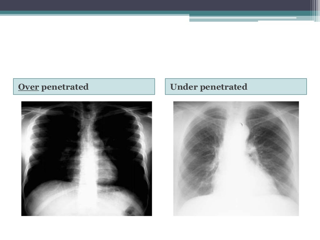 Chest x ray positioning