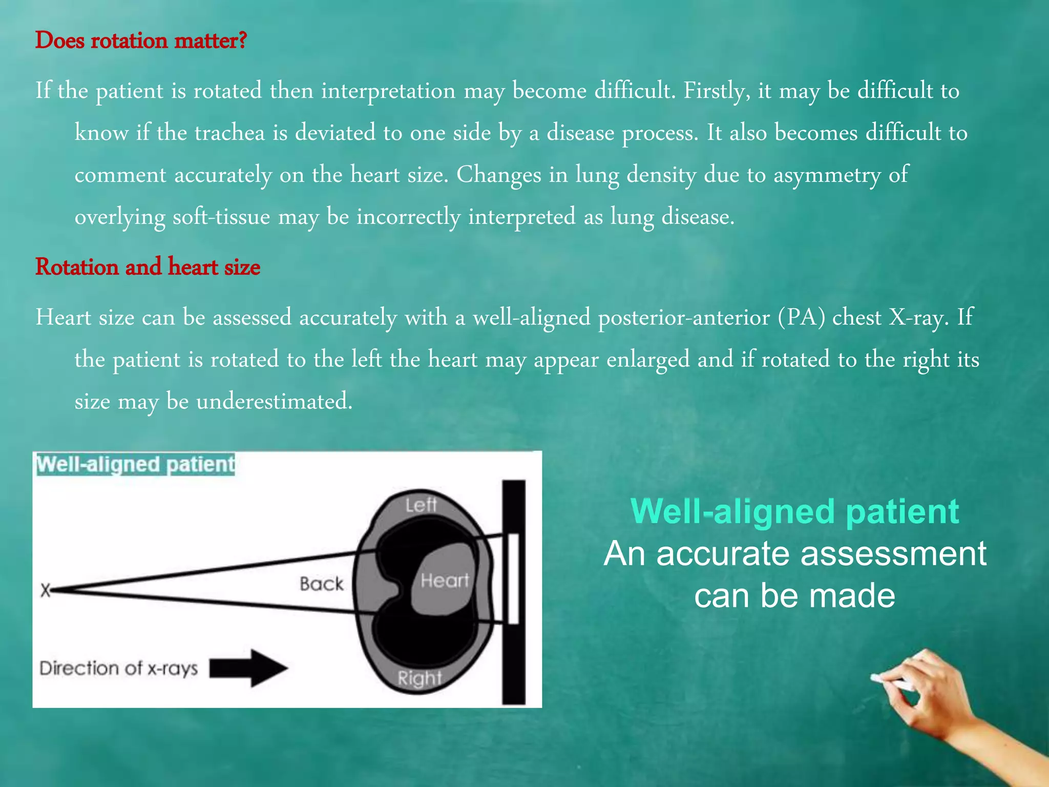 Chest x ray quality - how to interpret chest x-ray (1) | PPTX