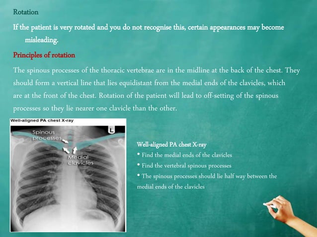 Chest x ray quality - how to interpret chest x-ray (1) | PPTX