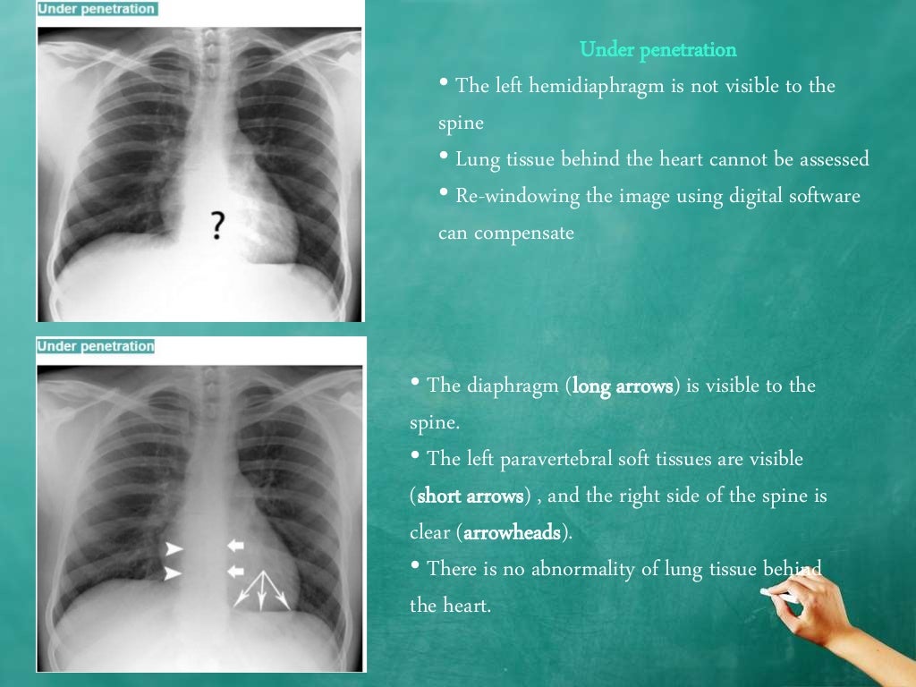 Chest x ray quality how to interpret chest xray (1)