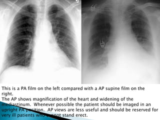 Chest X-ray radiology_Power Point Presentation | PPTX