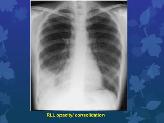 Chest x ray review. | PPTX