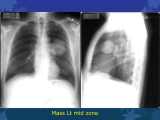 Chest x ray review. | PPTX