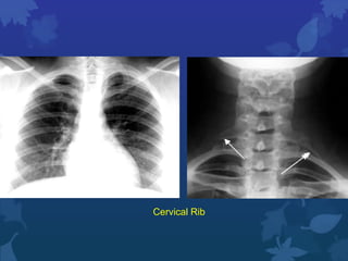 Cervical Rib On Radiograph Chest x ray review. | PPTX