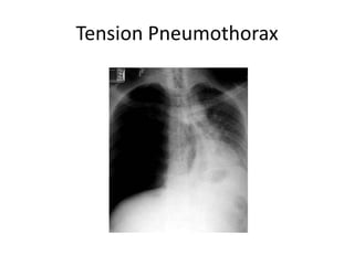 Tension Pneumothorax
 