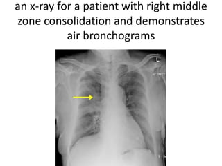 an x-ray for a patient with right middle
zone consolidation and demonstrates
           air bronchograms
 