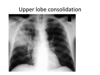 Upper lobe consolidation
 