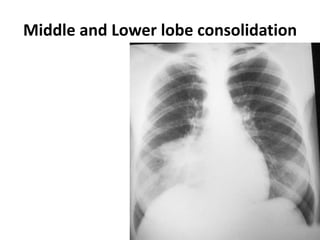 Middle and Lower lobe consolidation
 