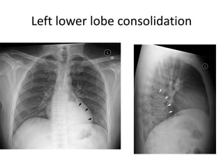 Left lower lobe consolidation
 