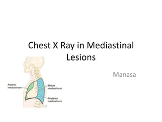 Chest X Ray in Mediastinal
         Lesions
                    Manasa
 