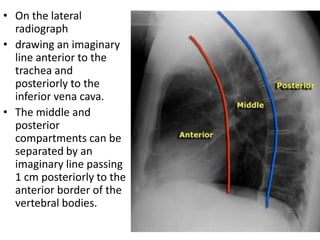 • On the lateral
  radiograph
• drawing an imaginary
  line anterior to the
  trachea and
  posteriorly to the
  inferior vena cava.
• The middle and
  posterior
  compartments can be
  separated by an
  imaginary line passing
  1 cm posteriorly to the
  anterior border of the
  vertebral bodies.
 