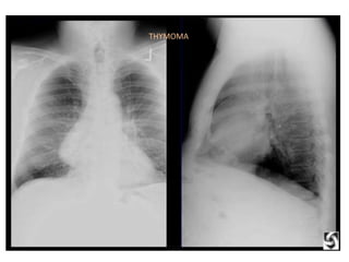 THYMOMA



• thymoma
 