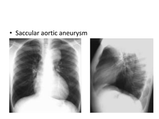 • Saccular aortic aneurysm
 