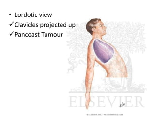 • Lordotic view
Clavicles projected up
Pancoast Tumour
 
