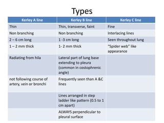 Types
       Kerley A line             Kerley B line                    Kerley C line
Thin                      Thin, transverse, faint         Fine
Non branching             Non branching                   Interlacing lines
2 – 6 cm long             1 -3 cm long                    Seen throughout lung
1 – 2 mm thick            1- 2 mm thick                   “Spider web” like
                                                          appearance
Radiating from hila       Lateral part of lung base
                          extending to pleura
                          (common in costophrenic
                          angle)
not following course of   Frequently seen than A &C
artery, vein or bronchi   lines

                          Lines arranged in step
                          ladder like pattern (0.5 to 1
                          cm apart)
                          ALWAYS perpendicular to
                          pleural surface
 
