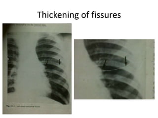 Thickening of fissures
 