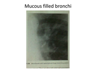 Mucous filled bronchi
 