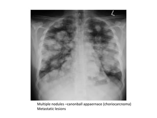 Multiple nodules –canonball appaernace (choriocarcnoma)
Metastatic lesions
 