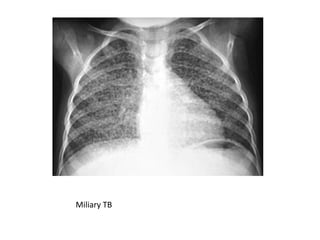 Miliary TB
 