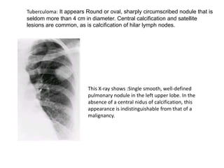 Tuberculoma: It appears Round or oval, sharply circumscribed nodule that is
seldom more than 4 cm in diameter. Central calcification and satellite
lesions are common, as is calcification of hilar lymph nodes.




                        This X-ray shows :Single smooth, well-defined
                        pulmonary nodule in the left upper lobe. In the
                        absence of a central nidus of calcification, this
                        appearance is indistinguishable from that of a
                        malignancy.
 