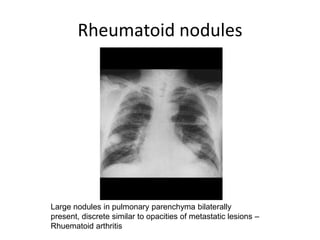 Rheumatoid nodules




Large nodules in pulmonary parenchyma bilaterally
present, discrete similar to opacities of metastatic lesions –
Rhuematoid arthritis
 