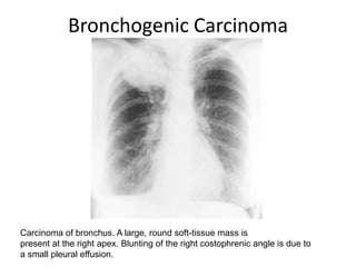 Bronchogenic Carcinoma




Carcinoma of bronchus. A large, round soft-tissue mass is
present at the right apex. Blunting of the right costophrenic angle is due to
a small pleural effusion.
 
