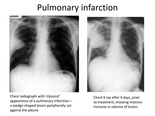 Pulmonary infarction




Chest radiograph with ‘classical’        Chest X ray after 4 days, prior
appearance of a pulmonary infarction –   to treatment, showing massive
a wedge-shaped lesion peripherally set   increase in volume of lesion.
against the pleura
 
