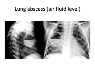 Lung abscess (air fluid level)
 