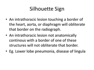 Silhouette Sign
• An intrathoracic lesion touching a border of
  the heart, aorta, or diaphragm will obliterate
  that border on the radiograph.
• An intrathoracic lesion not anatomically
  continous with a border of one of these
  structures will not obliterate that border.
• Eg. Lower lobe pneumonia, disease of lingula
 